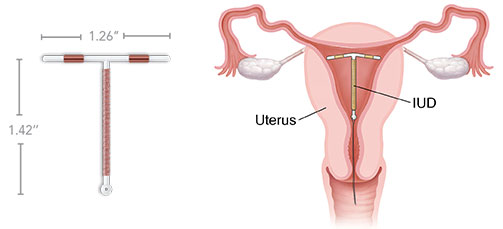 paragard-copper-iud-size-placement