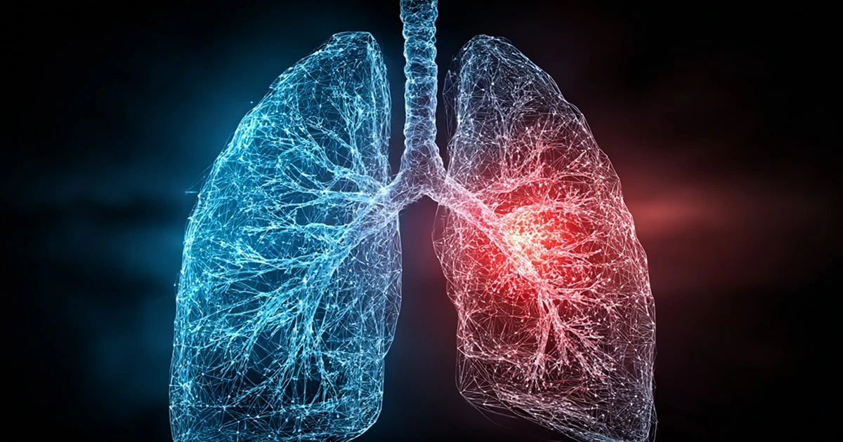 Digital illustration of human lungs showing blood clot and pulmonary embolism risk