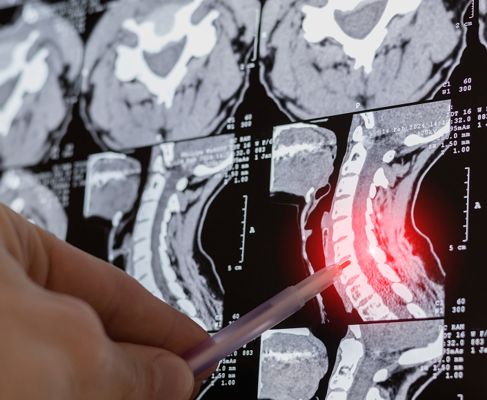 Doctor pointing to spinal cord injury on MRI scan, highlighting severe trauma and medical evaluation.
